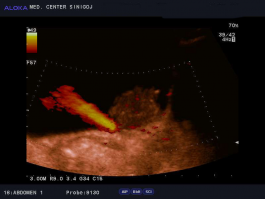 Ultrazvok mehurja - tumor mehurja in jet urina iz levega ostija